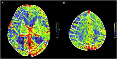 Feasibility of FDCT Early Brain Parenchymal Blood Volume Maps in Predicting Short-Term Prognosis in Patients With Aneurysmal Subarachnoid Hemorrhage